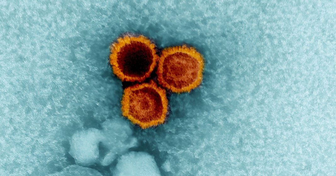 A new study hints the common Epstein-Barr virus could be behind lupus. A new study hints the common Epstein-Barr virus could be behind lupus.