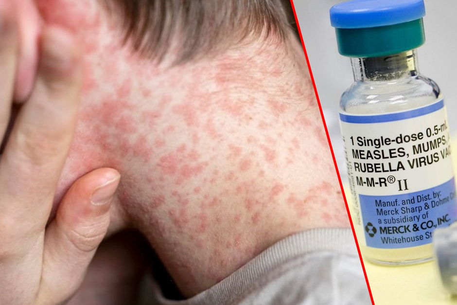 An Ichilov doctor caught measles after treating an unvaccinated child An Ichilov doctor caught measles after treating an unvaccinated child