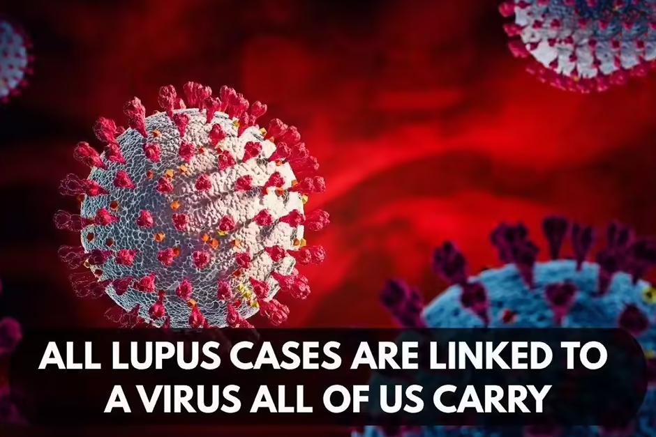 All lupus cases are linked to a virus all of us carry, study finds