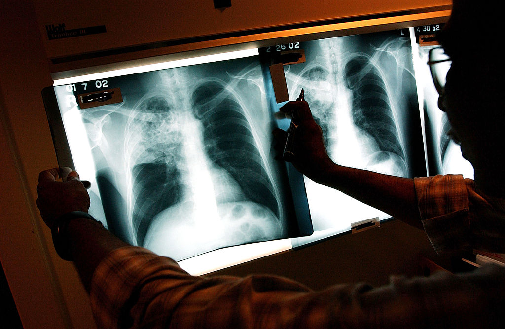 A resident at a Washington senior living facility has tested positive for tuberculosis.