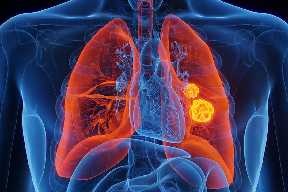 Lung cancer: New blood test can find cancer one cell at a time Lung cancer: New blood test can find cancer one cell at a time