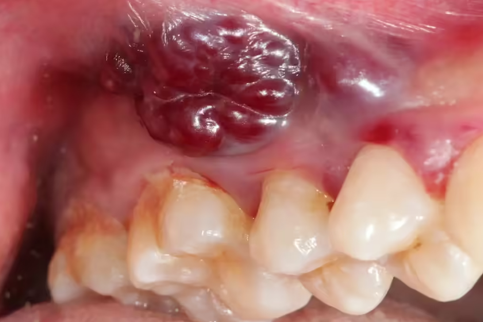 Indian women and growing oral cancer cases: Why a non-healing mouth ulcer could be the earliest red flag