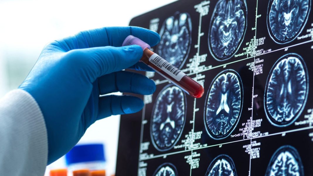 Scientists get a clearer picture of Alzheimer's early signs. Scientists get a clearer picture of Alzheimer's early signs.