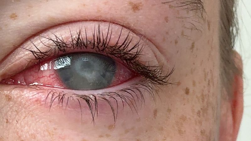 Wear contacts? You need to know about this blinding eye parasite – and how to avoid it.