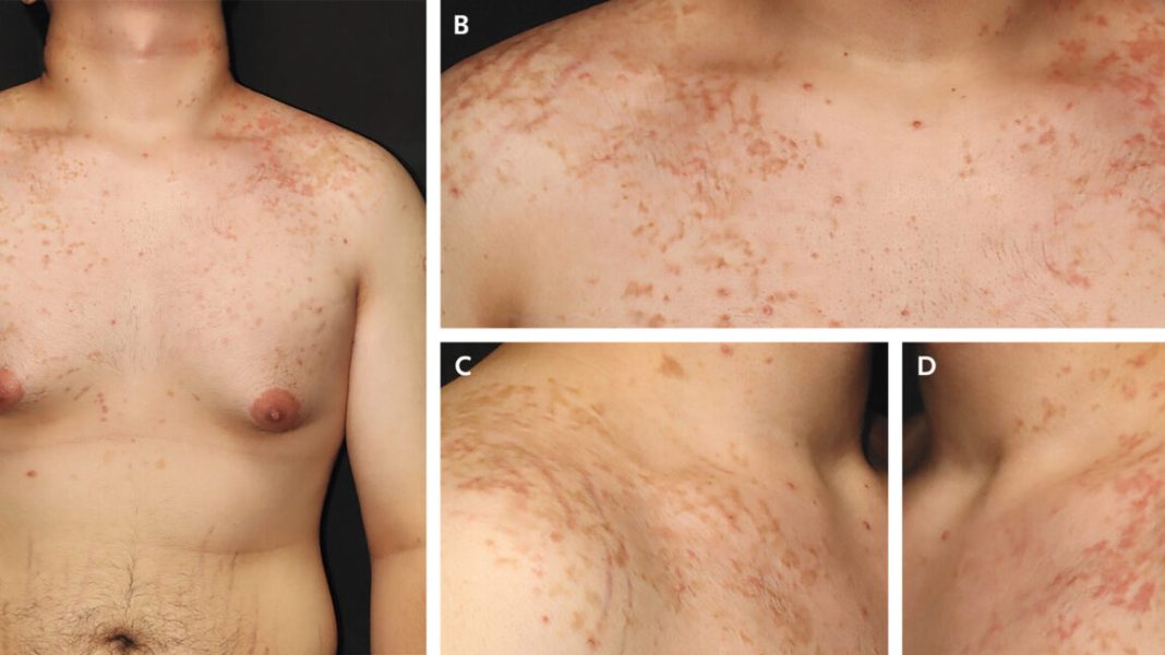 A weird, itchy rash is showing up with the keto diet, and no one knows why.