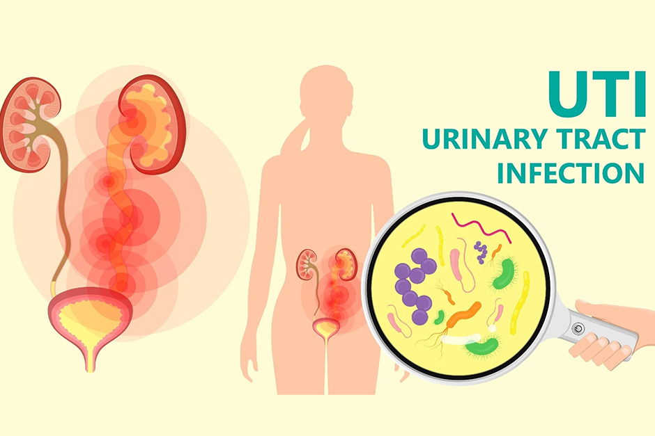 Uncomplicated Urinary Tract Infections in Care Uncomplicated Urinary Tract Infections in Care