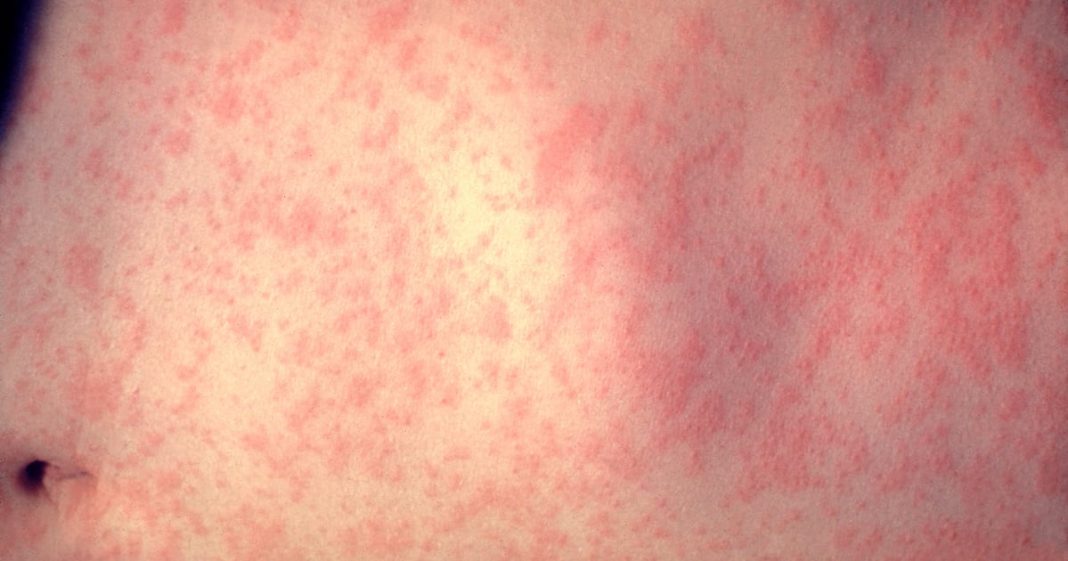 A measles case has turned up in Georgia. A measles case has turned up in Georgia.
