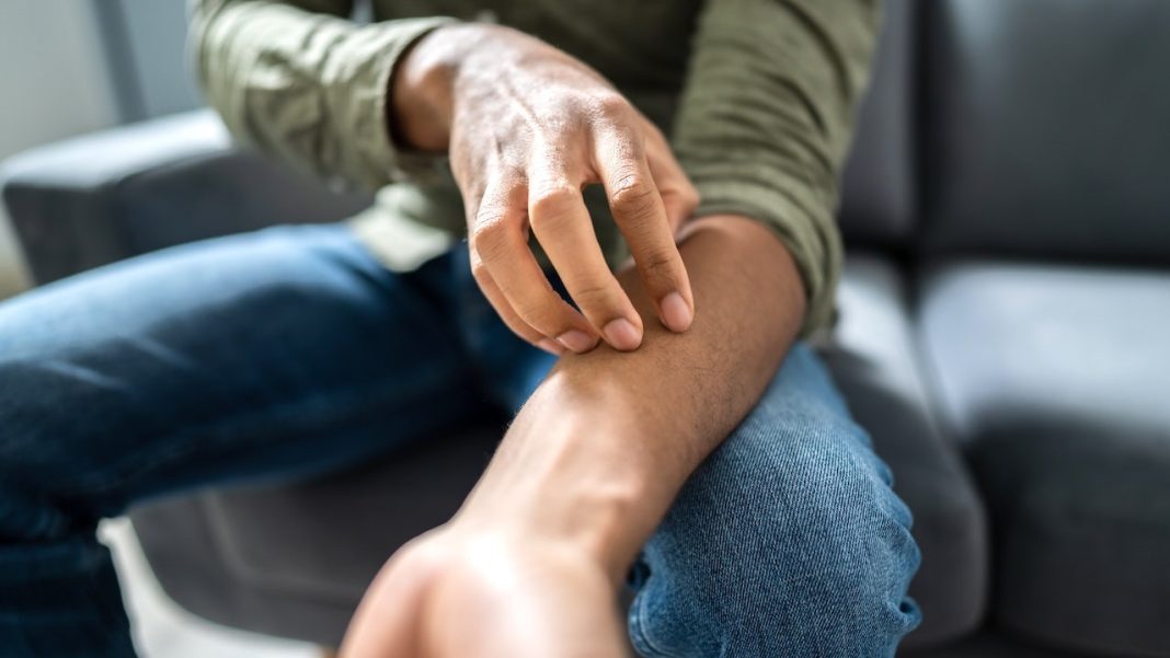 Health officials confirm a sexually transmitted fungal infection has broken out. Doctors are urging caution.