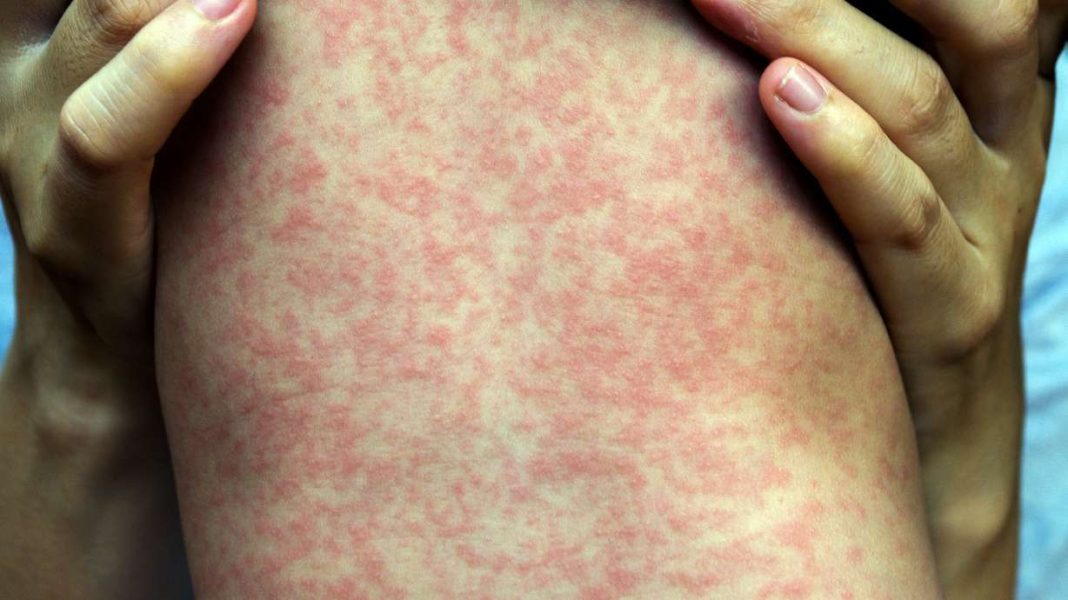 Measles Confirmed After Utah Wrestling Tournament; Health Alert Issued Measles Confirmed After Utah Wrestling Tournament; Health Alert Issued