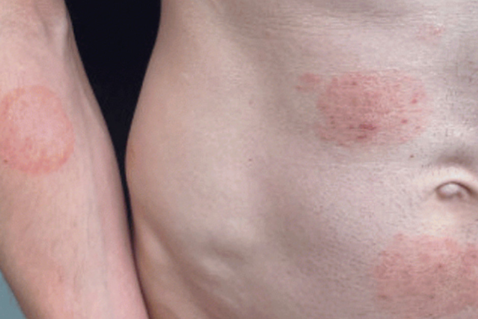 Health officials confirm a sexually transmitted fungal infection has broken out. Doctors are urging caution. Health officials confirm a sexually transmitted fungal infection has broken out. Doctors are urging caution.