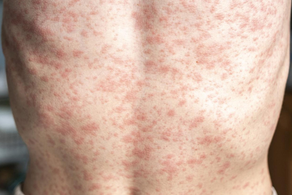 Heads Up: Measles is incredibly contagious, and cases are skyrocketing nationwide. What you need to know.