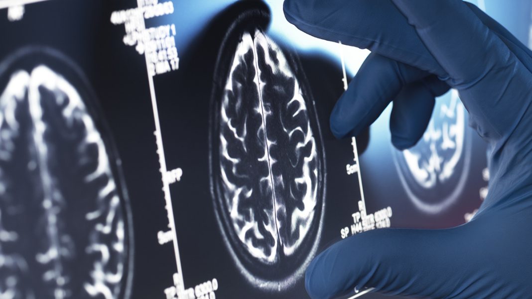 Viagra could be a top existing candidate for Alzheimer's treatment. Viagra could be a top existing candidate for Alzheimer's treatment.