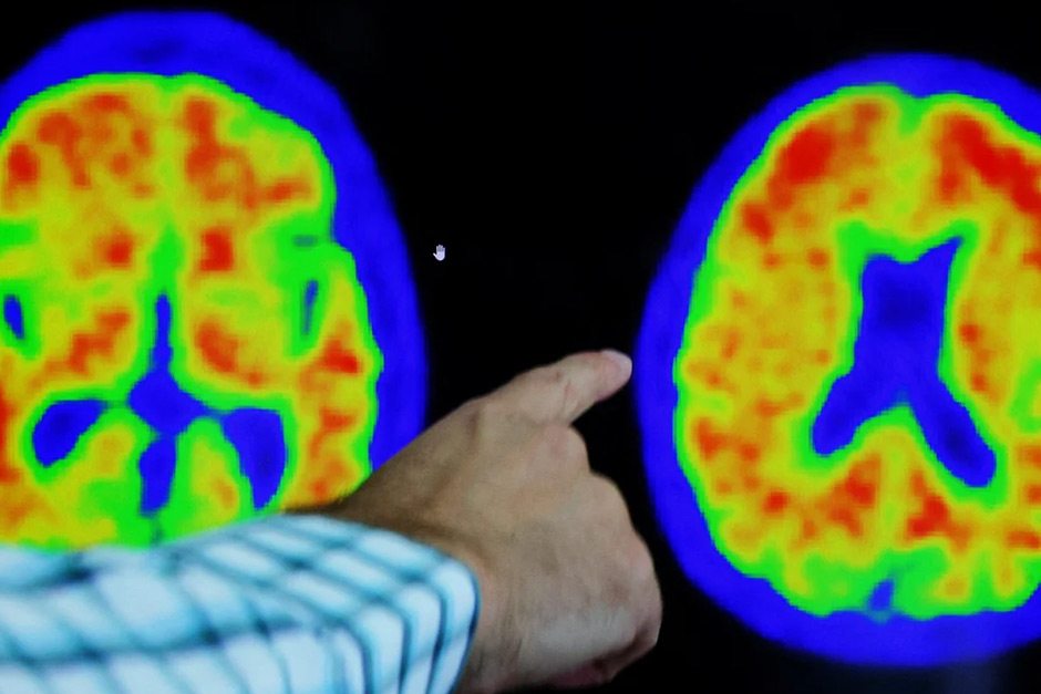 Scientists uncover a subtle threat to brain health that raises Alzheimer’s risk.