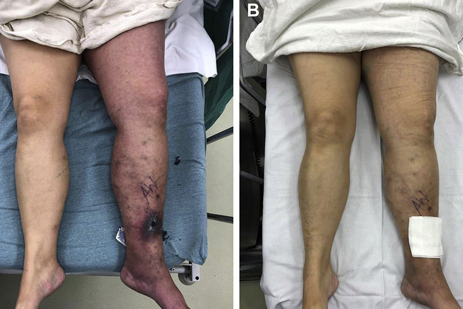 Saving Thrombectomy in Severe DVT Case