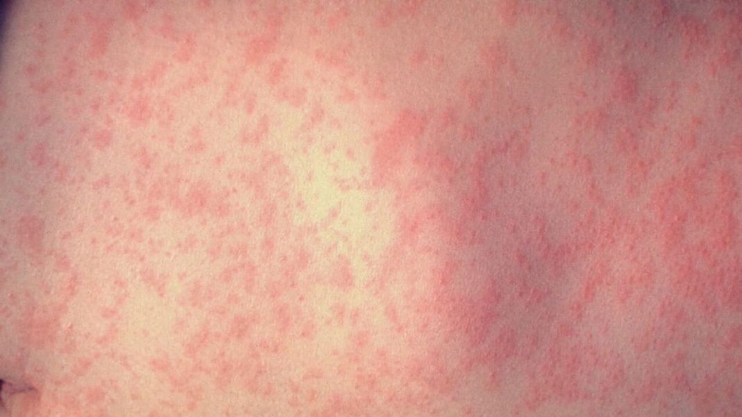Measles Alert: Health Officials Confirm Case at Portland Safeway Measles Alert: Health Officials Confirm Case at Portland Safeway