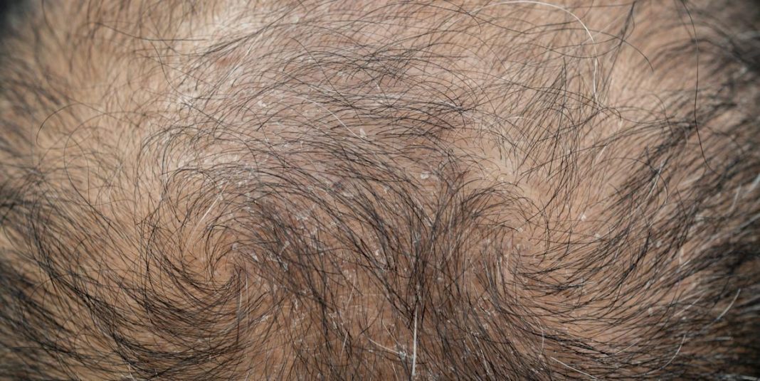 Scientists discovered a chemical that could help regrow your hair – and it might already be in your pantry.