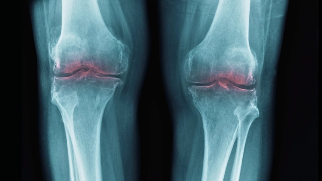 This breakthrough could restore aging joints, bringing relief for osteoarthritis.