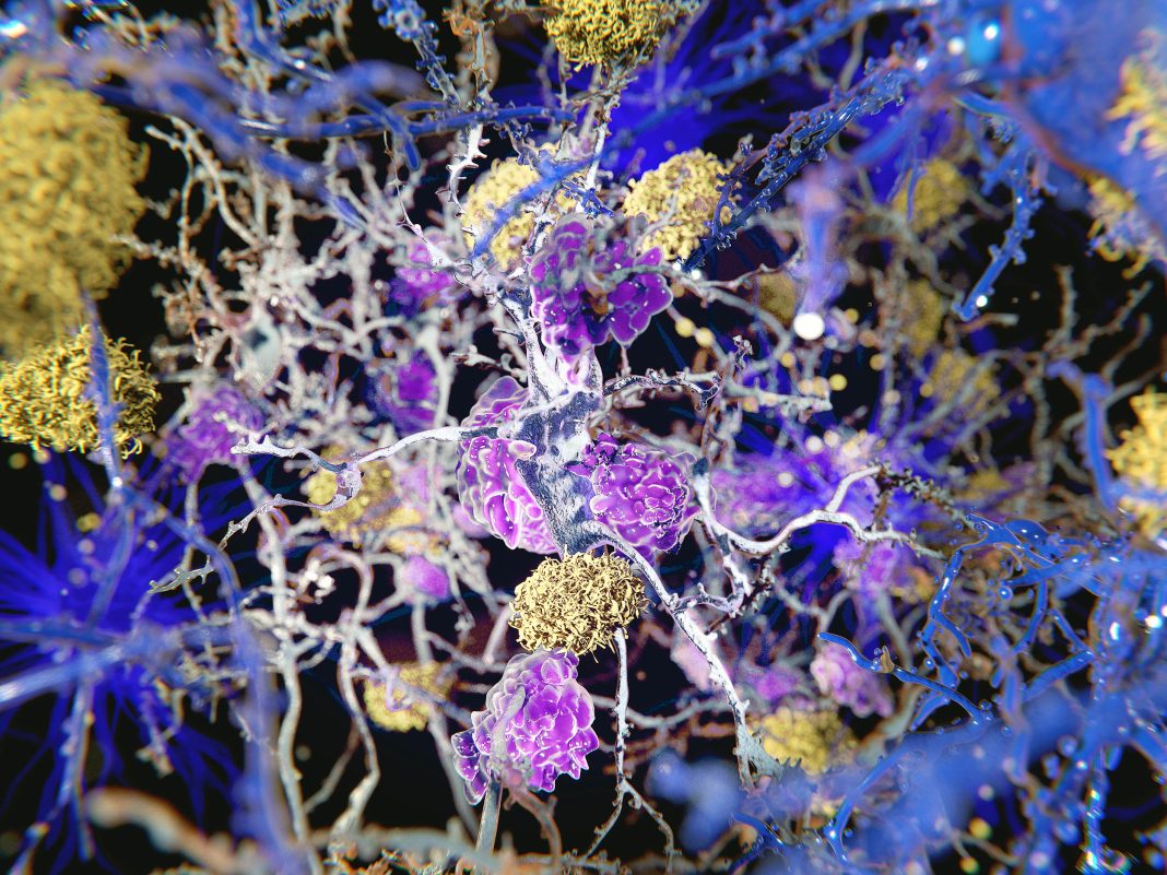 It turns out Alzheimer's might begin in body inflammation, not the brain.