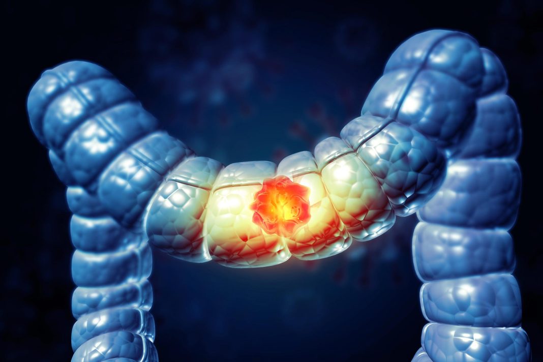 Arre Wah! Scientists Crack 15-Year Gut Toxin Mystery Behind Cancer
