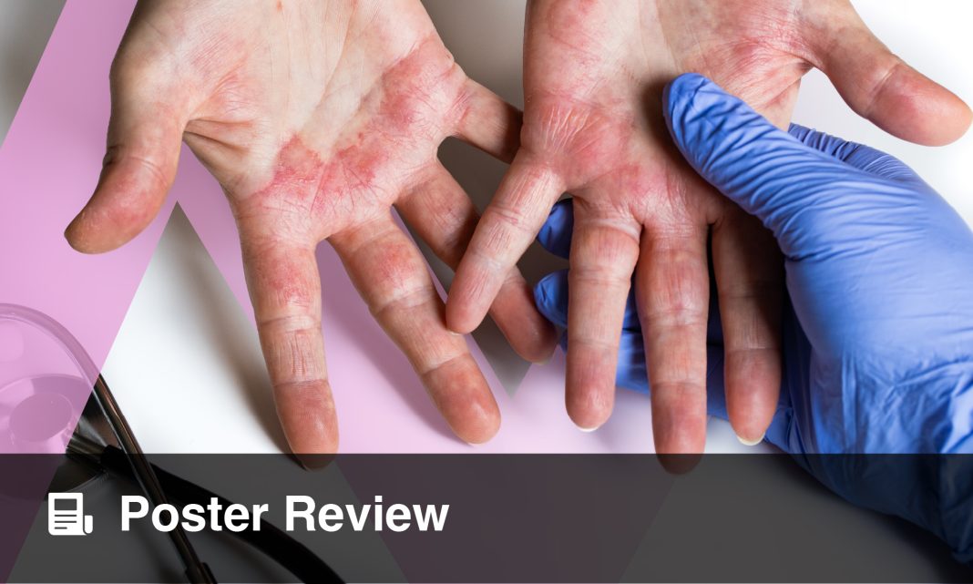 Treatment of High-Burden Areas of Atopic Dermatitis: A Review of Recent Real-World Evidence and Clinical Trial Data Treatment of High-Burden Areas of Atopic Dermatitis: A Review of Recent Real-World Evidence and Clinical Trial Data