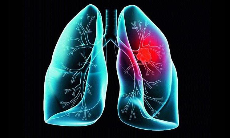 New Experimental Cancer Drug Removes Tumours’ ‘Invisibility Cloak’, Early Trial Shows New Experimental Cancer Drug Removes Tumours’ ‘Invisibility Cloak’, Early Trial Shows